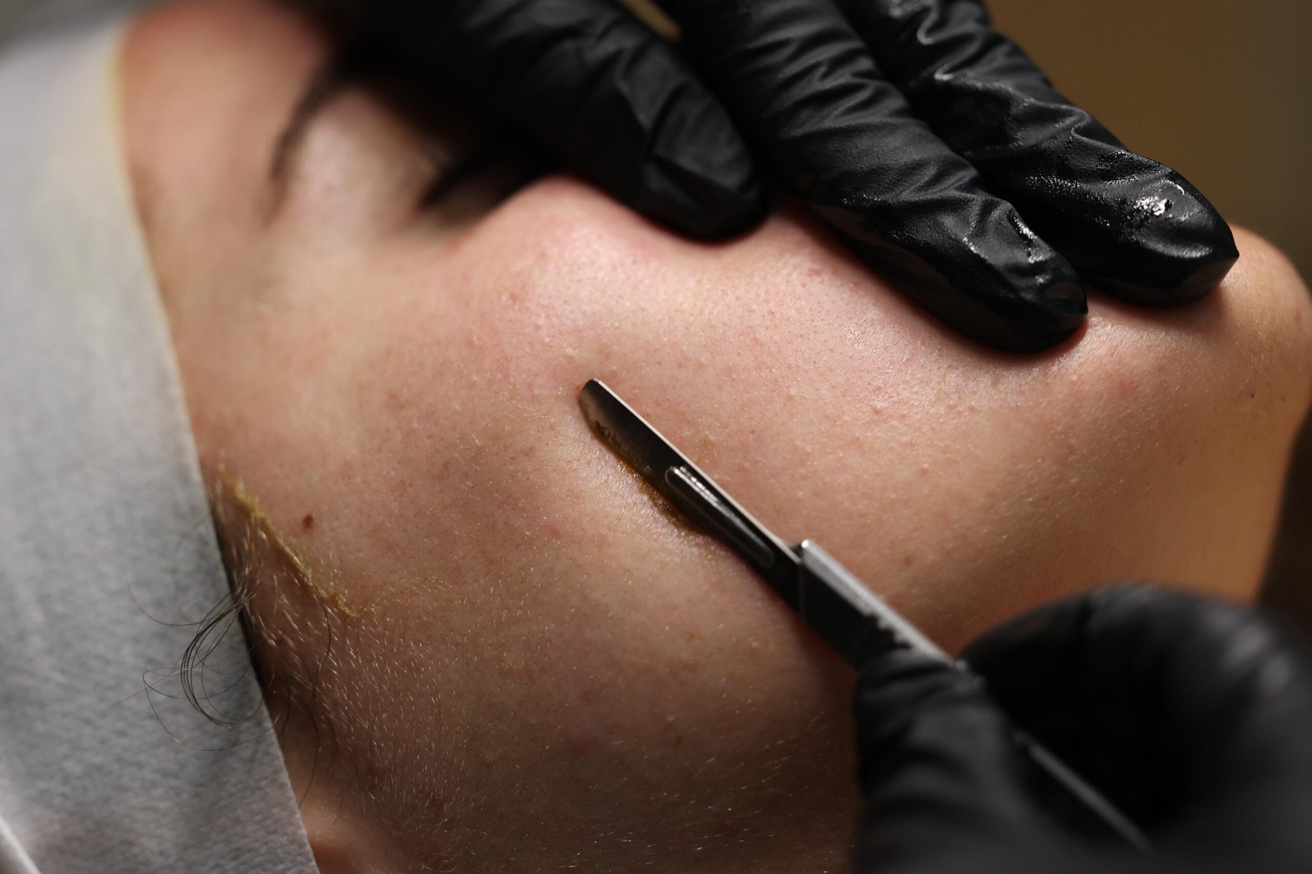 Dermaplaning Facial&nbsp;