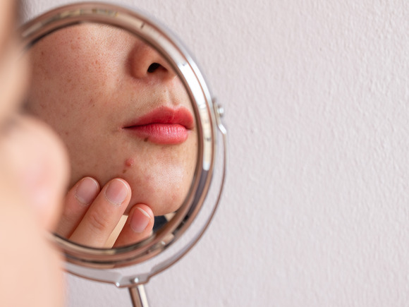 Classic European Facial: Your Secret Weapon Against Acne and Oily Skin