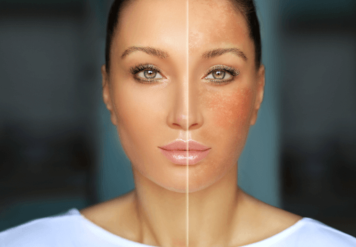 Unveiling the Mystery of Hyperpigmentation: Causes, Treatments, and a Path to Even-Toned Skin 