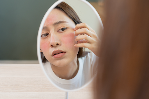 Soothing Your Skin: Expert Advice for Managing Face Eczema