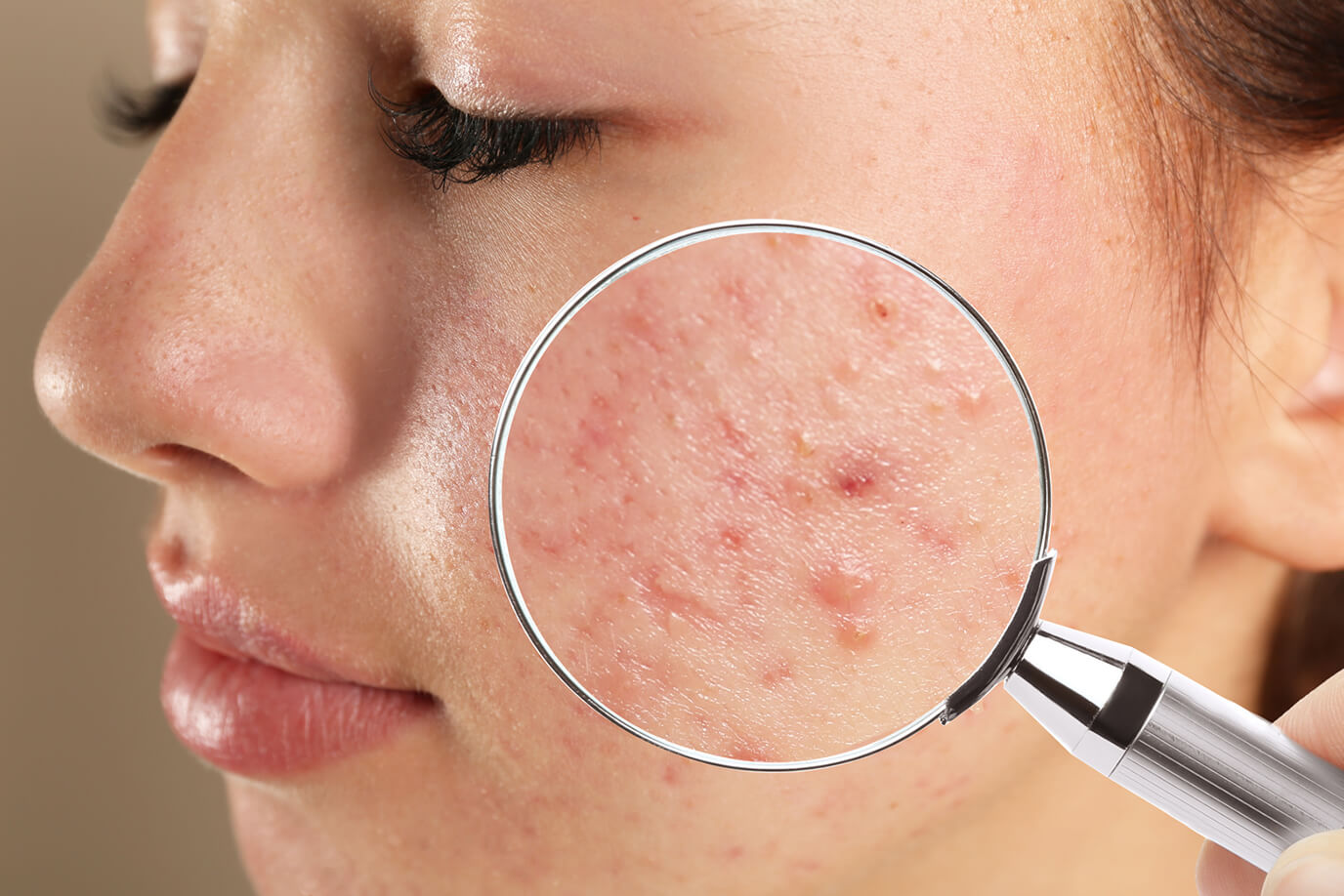 Acne Treatment for Teenagers