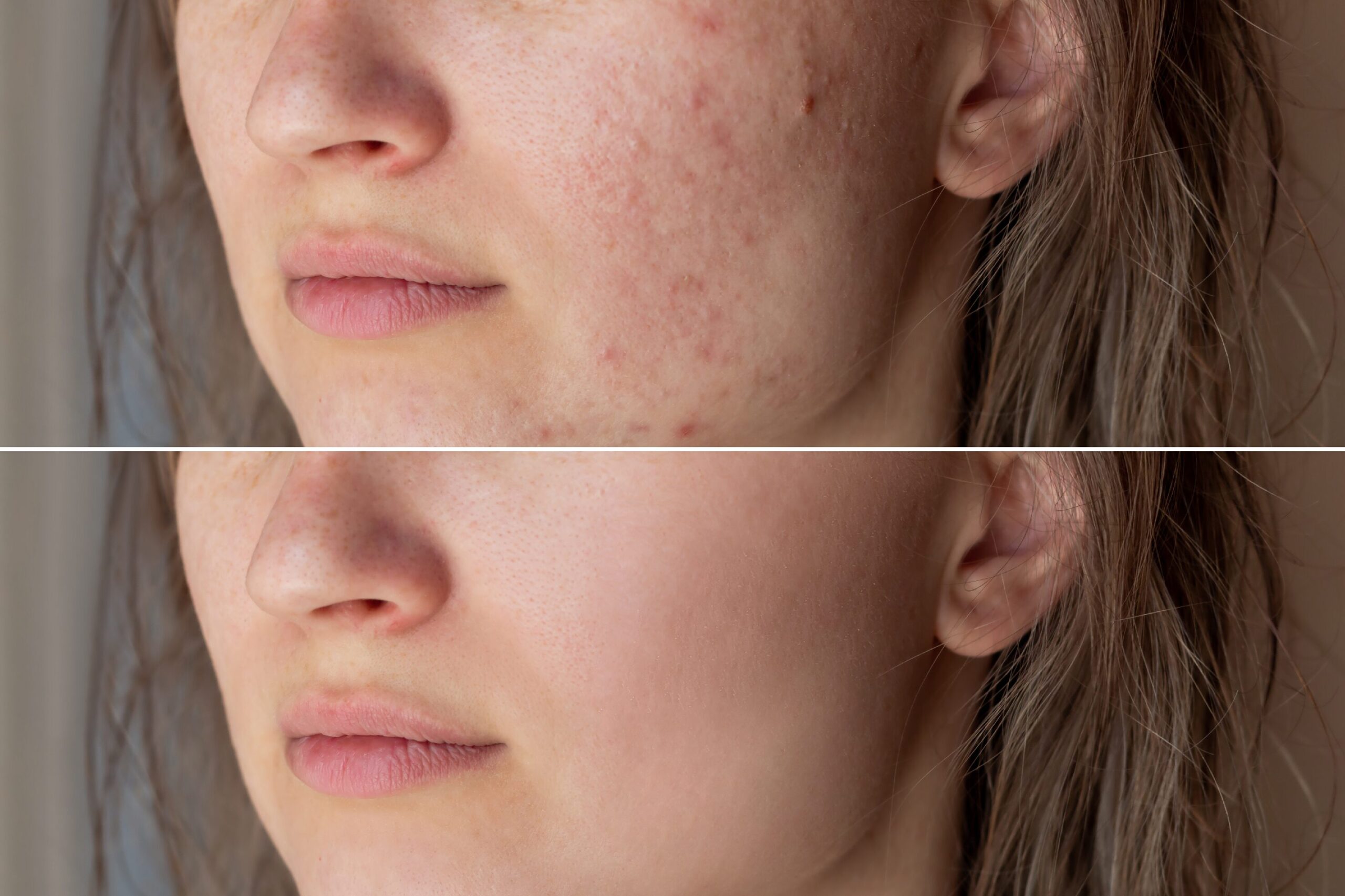 Fading Scars, Revealing Confidence: A Guide to Acne Scar Removal
